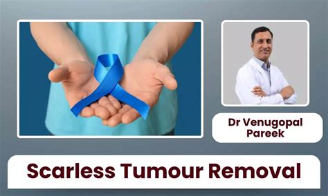 High Tech in Gut Care: Surgeons Remove Tumours With No Incision, No ...