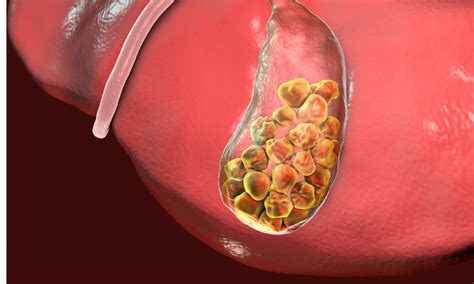 Cholelithiasis tied to increased risk of prostate cancer, suggests study