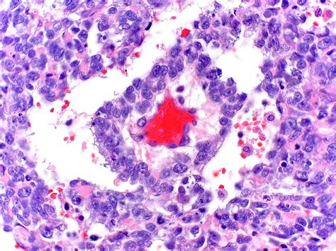 Tumeur Du Sac Vitellin Corps De Schiller Duval