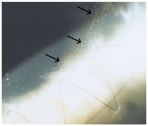 Managing Post-Keratoplasty Astigmatism: High-Tech vs. Low-Tech Imaging ...