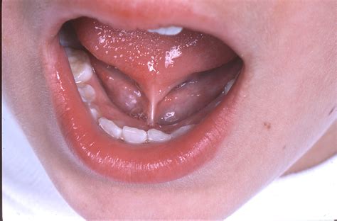 Consequences of Untreated Tongue Tie - Tongue Tie