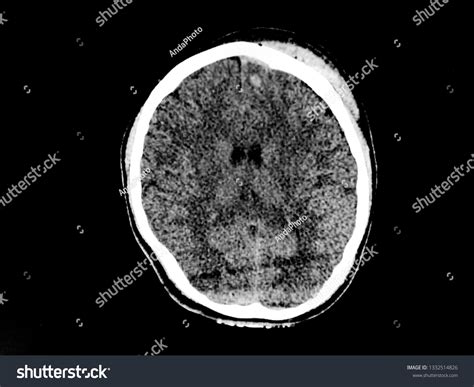 Ct Scan Brain Showed Subdural Hematoma Stock Photo (Edit Now) 1332514826
