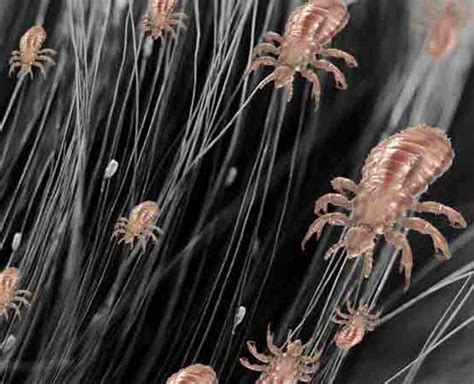 How to Get Rid of Lice Super Fast | how to get rid of lice super fast ...