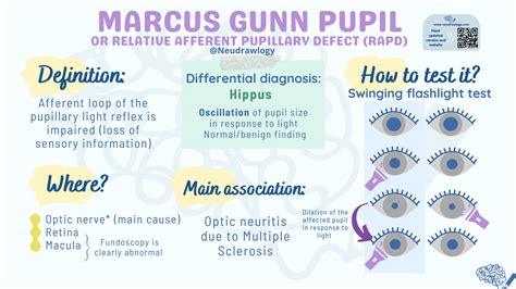 Marcus-Gunn pupil — Neudrawlogy: Simplifying Neurology