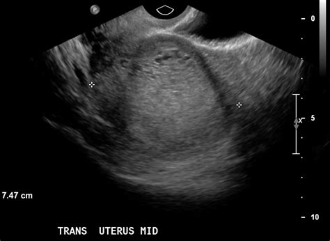 Molar Pregnancy - Radshare