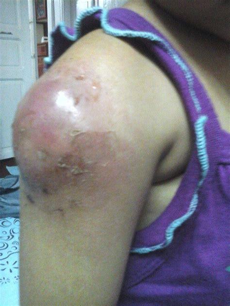 Image result for Painful Giant Abscess Exploding