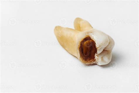 Image result for Pulled Tooth