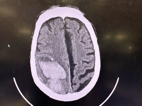 Bleed with a midline shift….s/p fall on thinners : r/Radiology