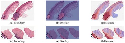 Region of Interest Detection in Melanocytic Skin Tumor Whole Slide ...