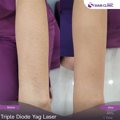 Hair Removal Laser Before and After Photos - Siam Clinic Thailand