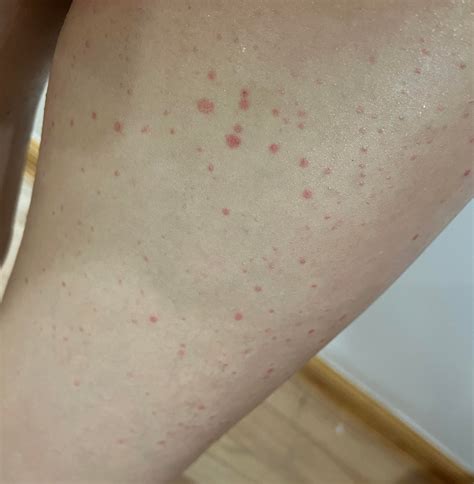 Red spots on my legs : r/DermatologyQuestions