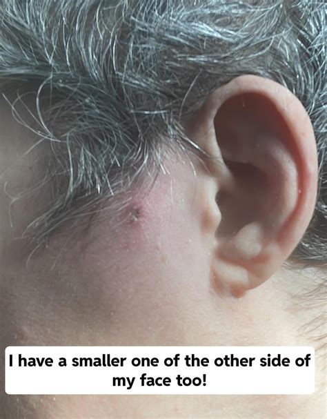 Image result for Painful Giant Abscess Exploding