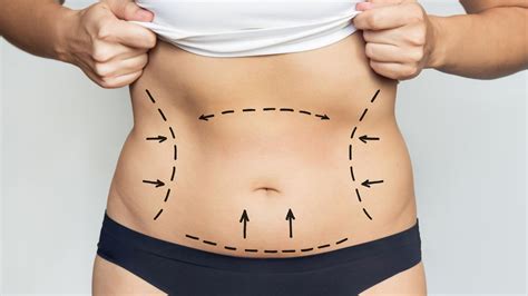 Is it safe to have liposuction in Turkey? | Dr. Gozde Erten Ankara