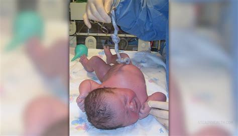 Bildergebnis für umbilical cord around neck complications