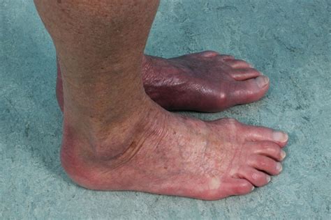Asymmetric red-bluish foot due to acrodermatitis chronica atrophicans ...