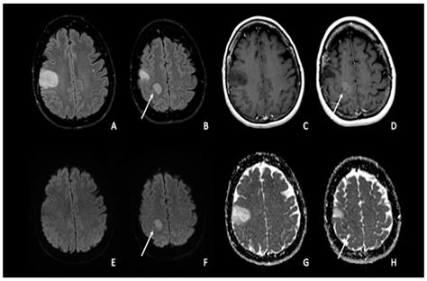 Diffusion Weighted Imaging in Neuro-Oncology: Diagnosis, Post-Treatment Changes, and Advanced ...