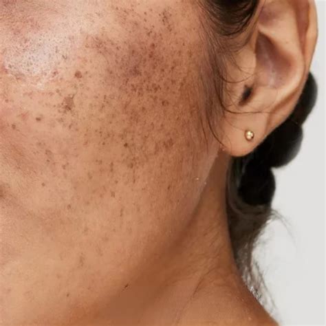 What Is Hyperpigmentation? Its Signs, Causes & Types