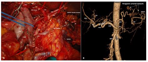 Three Types of Collateral Arterial Supply to the Spleen After Spleen ...