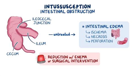 Image result for Intussusception Symptoms