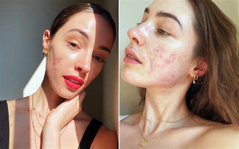 5 Skin-Positive Influencers Aiming To Bring Change In Beauty Community ...