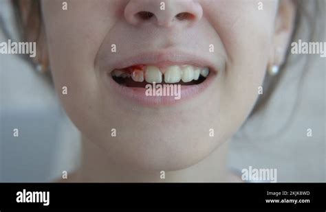 Image result for Pulled Tooth