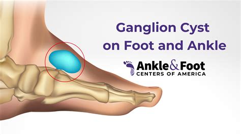 Lump On Top Of Foot Causes & Remedies