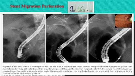 post ERCP pancreatitis.indications, cotraindications,types of ...