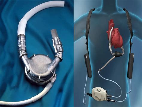 Ventricular Assist Device (VAD) Market Top Leading Companies