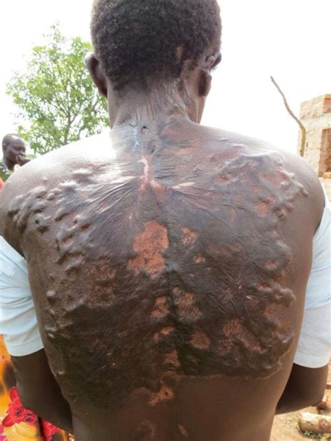 People hit by lightning reveal their scars which look like fern leaves ...