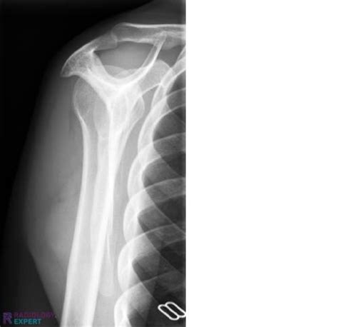 Image result for Normal Shoulder Alignment