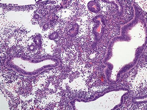 Pathology Outlines - Disordered proliferative