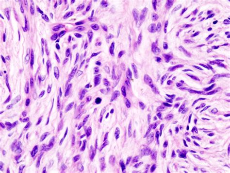 Image result for Dermatofibrosarcoma Protuberans