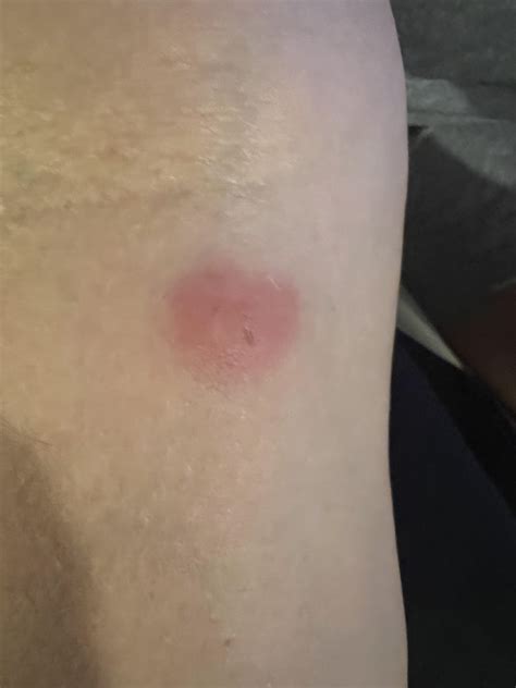 Scorpion Bite On Foot