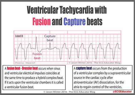 ECG Educator Blog : Is it VT?