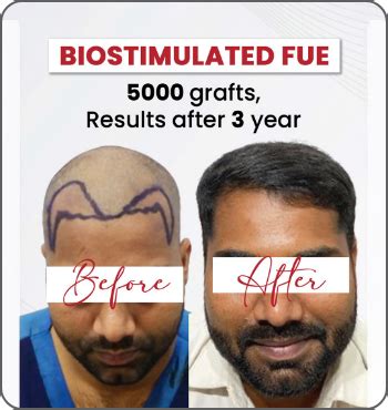 DermaClinix | Hair Transplant Results