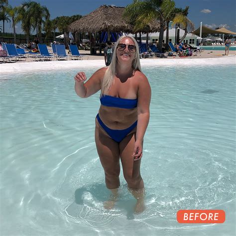 Before & After - Dr. William Miami