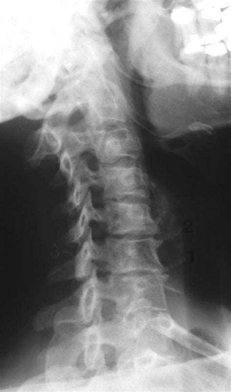 Cervical spondylosis and neck pain | The BMJ