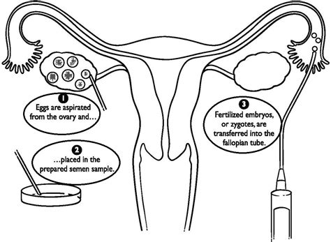 What is Assisted Reproductive Technology: Types and Advantages | AESL