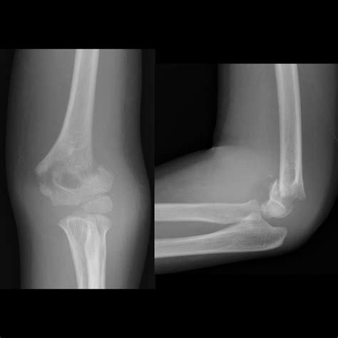 Medial Epicondyle Fracture