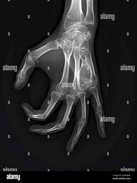 Aneurysmal bone cysts of the hand, X-ray Stock Photo - Alamy