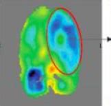 Brain Stroke - Cell Therapy