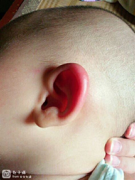 宝宝耳朵红肿怎么办 - 百度宝宝知道