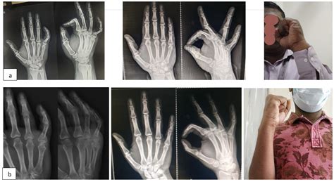 Proximal phalanx fracture treated with extension block Splint: An ...