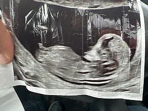 Boy or girl? Nub theory | BabyCenter