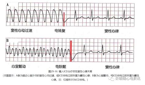 心室颤动心电图图片,心室颤动心电图,房颤心电图图片(第11页)_大山谷图库