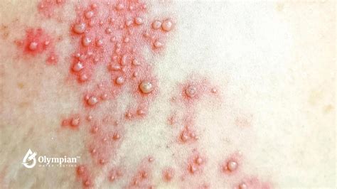 What bacteria commonly cause skin rashes from water exposure - Olympian ...