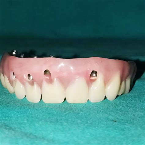 Best Dental implants in Noida| Dr Jains Dental