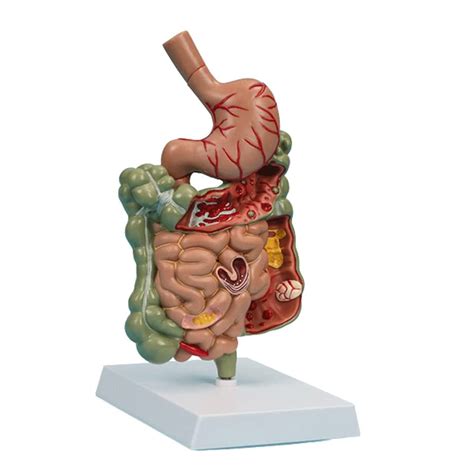Buy VNABO Medical Model Pathological Digestive System Model Human ...