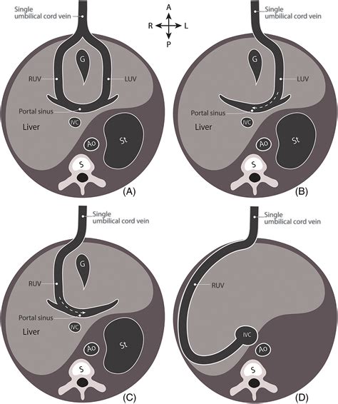 Persistent Right Umbilical Vein
