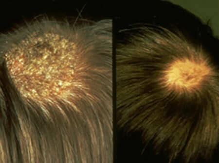 Everything You Need To Know About Hair Loss And More | Grazia India